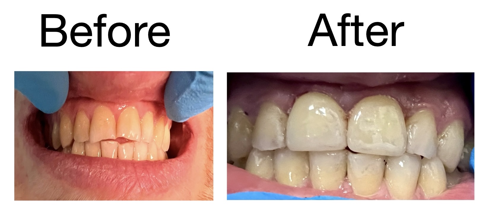 Porcelain Veneers - Before and After