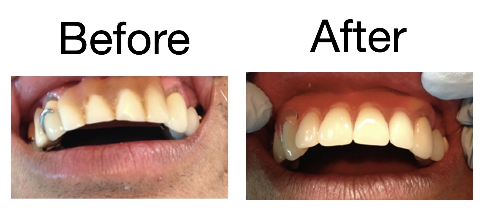 Valplast Partial Denture